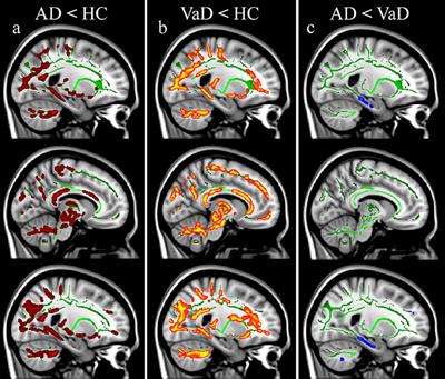 Specific Patterns of White Matter Alterations Help Distinguishing Alzheimer's and Vascular Dementia